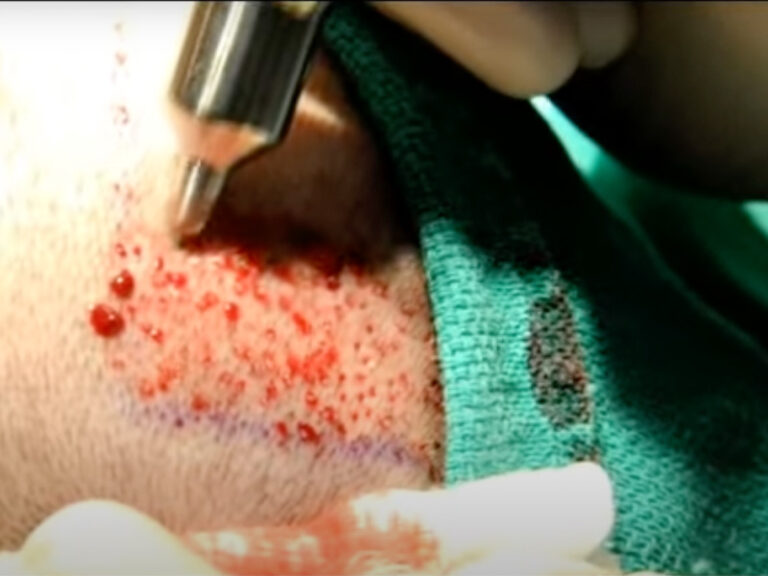 PCIDin action during FUE surgery procedure