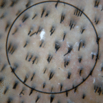 density of follicular units 2