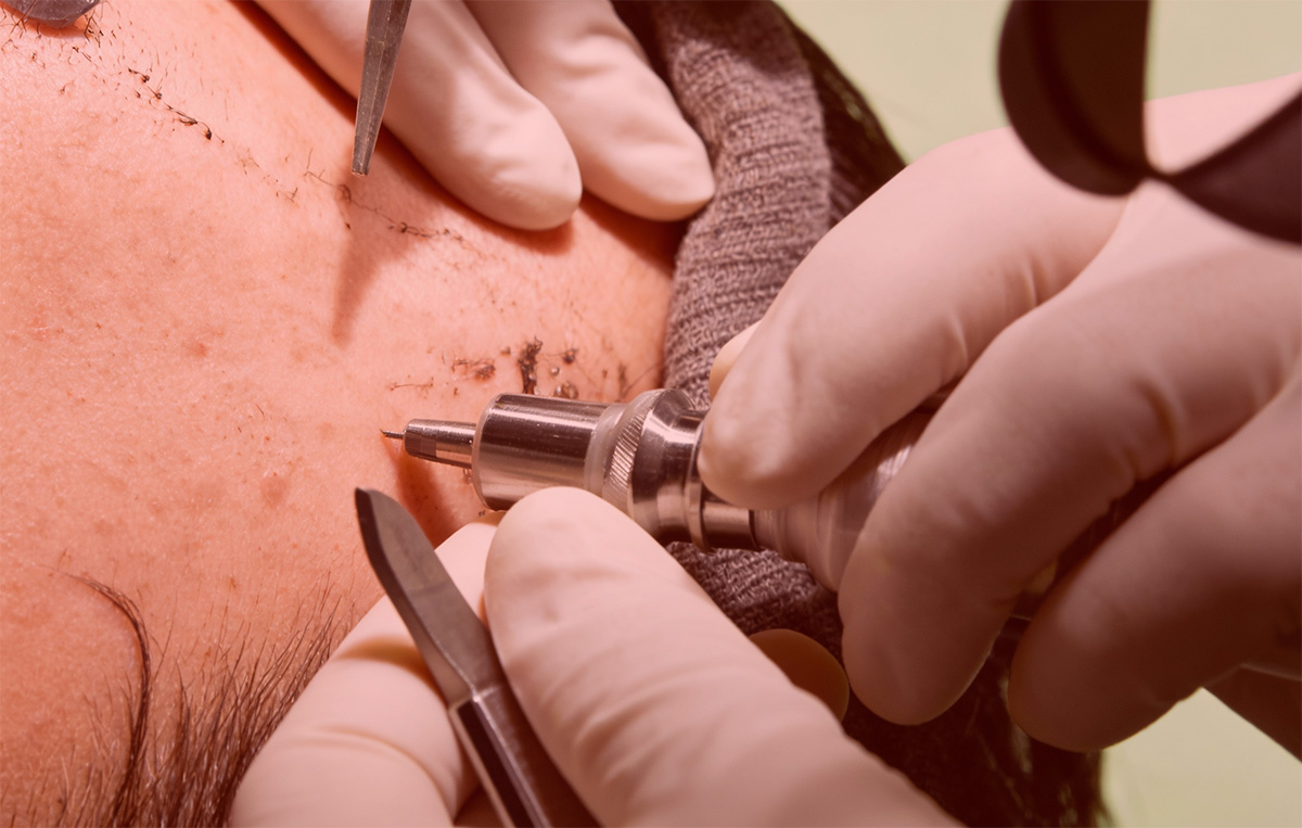 FUE punch extraction of hair follicle