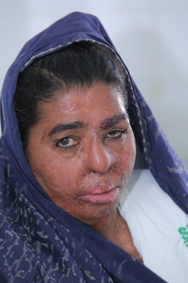Fatima eyebrow hair transplant