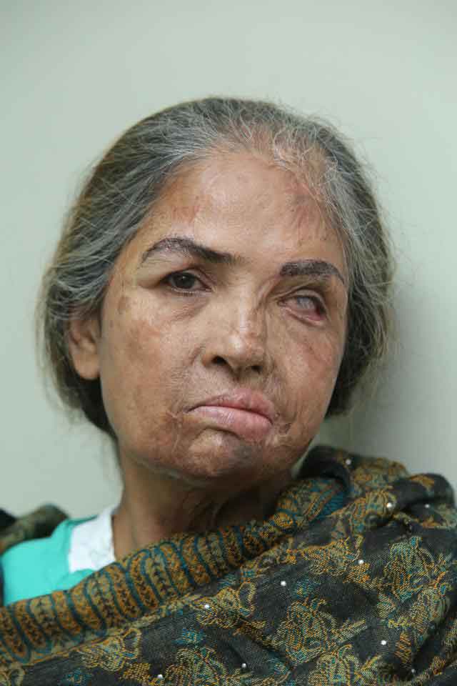 Niaz restore eyebrows